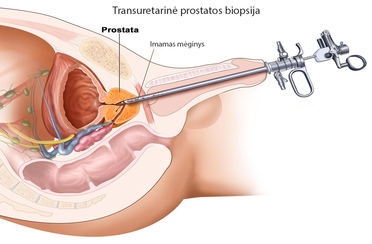 Transuretarinė prostatos biopsija
