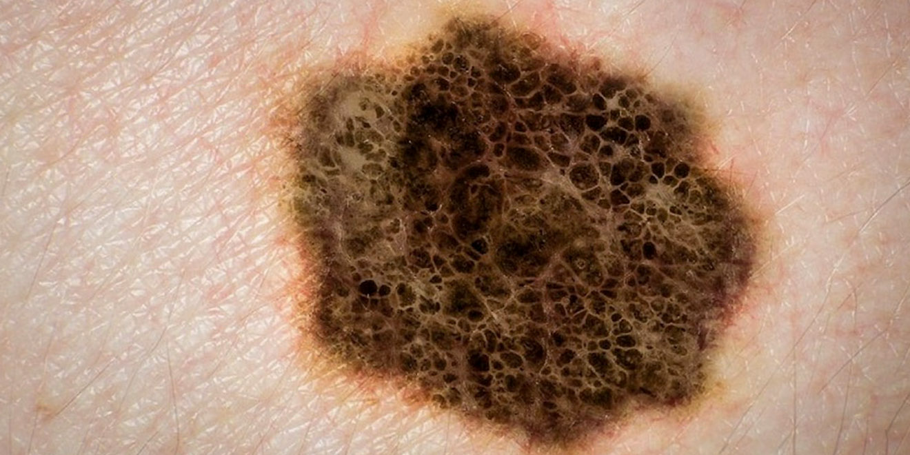 Piktybinė odos melanoma (vaizdai)